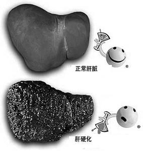 肝硬化