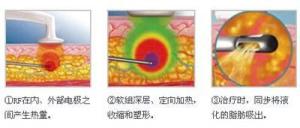 手术过程示意图