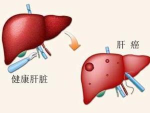 肝癌 搜狗百科