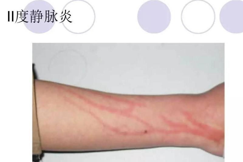 静脉炎 搜狗百科 静脉炎 搜狗百科
