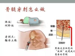 骨髓穿刺