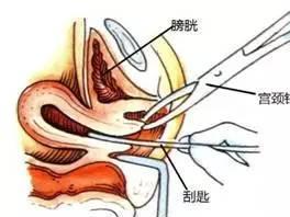 刮宫的过程图片