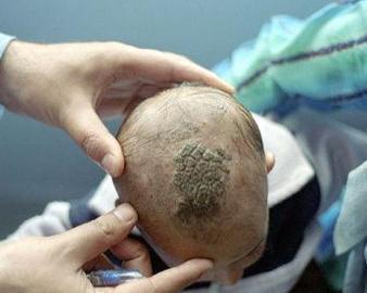 白癣- 搜狗百科