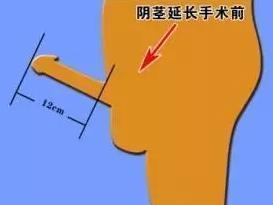 阴茎延长术