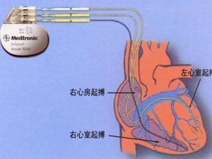心脏起搏器多久换一次图片