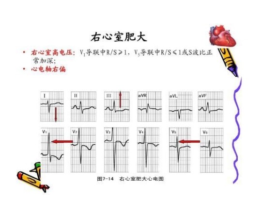 心电轴右偏 搜狗百科