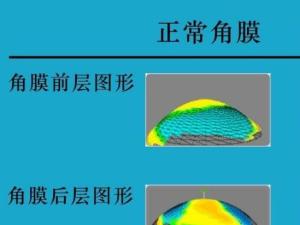 近视眼手术