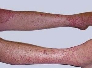 全身皮肤充血指全身皮肤毛细血管扩张,扩张的血管多为小静脉或小动脉