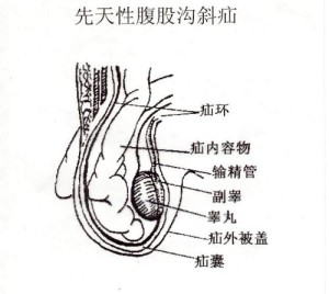 腹股沟管深环与浅环图图片