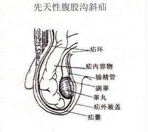 腹股沟管外口图片