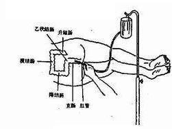 清洁灌肠