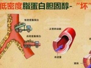 低密度脂蛋白-胆固醇