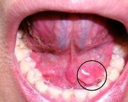 舌下腺囊肿大图片图片