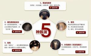 常见脱发类型