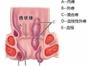 肛门脱出