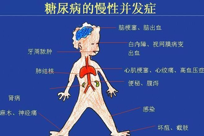 糖尿病并发症 搜狗百科