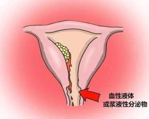 宫颈接触性出血图片图片
