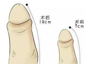 阴茎延长
