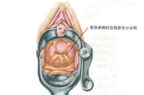 淋病 搜狗百科