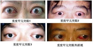 重度甲亢突眼