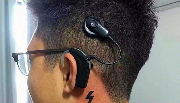 人工耳蜗