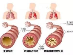 BA细胞免疫治疗