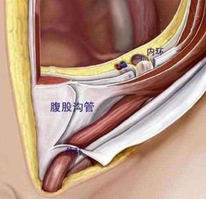 腹股沟管深环与浅环图图片