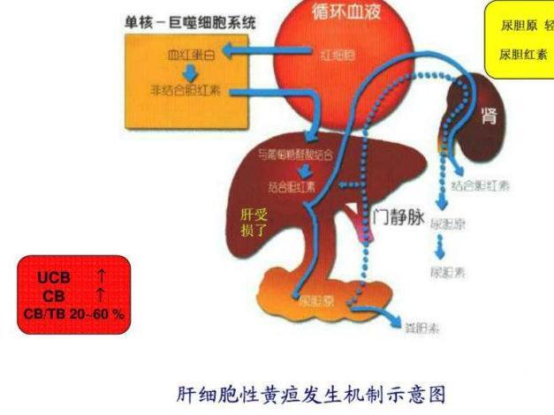 肝细胞性黄疸_搜狗百科