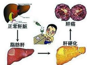 重度脂肪肝