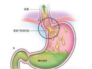 慢性浅表性胃炎