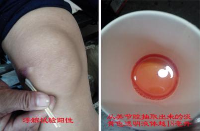 关节腔积液（图）