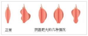 小阴唇肥大