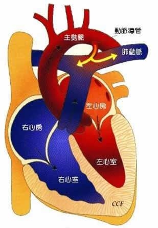 动脉导管的位置图片