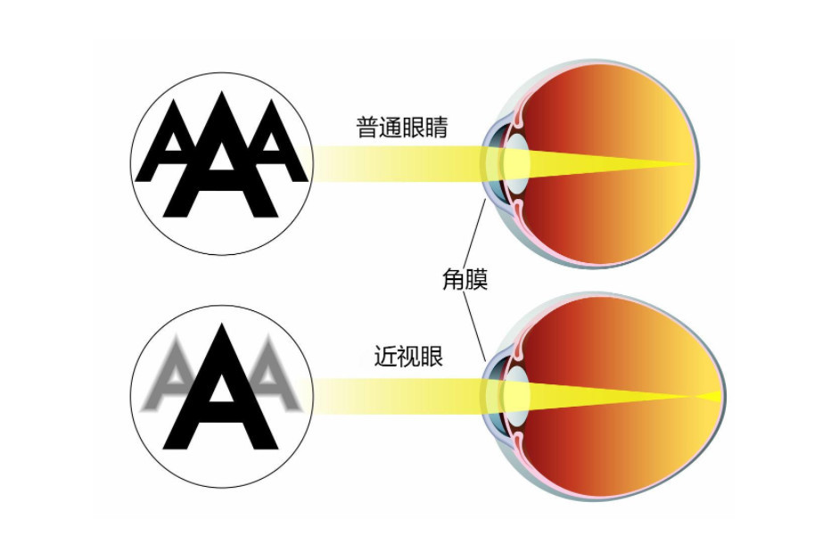 屈光 科学术语 搜狗百科