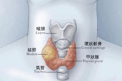 甲状腺癌 搜狗百科