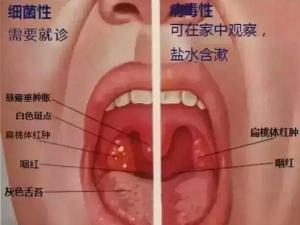 疱疹性咽炎