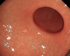 慢性非萎缩性胃炎