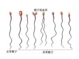 高畸形率精子