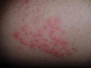 引起器官和组织的反应鉴别方式全身发痒,起红疙瘩,红斑点症状酒精过敏