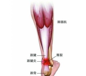 跟腱