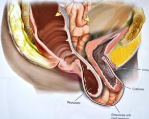 阴道后壁脱垂主要是由于耻骨尾骨肌纤维断裂所致,包括直肠膨出及肠
