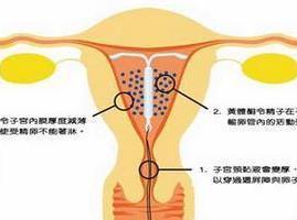子宫腺肌症