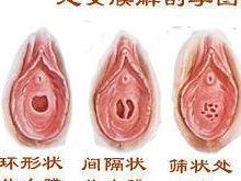外阴溃疡