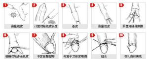 包皮环切术