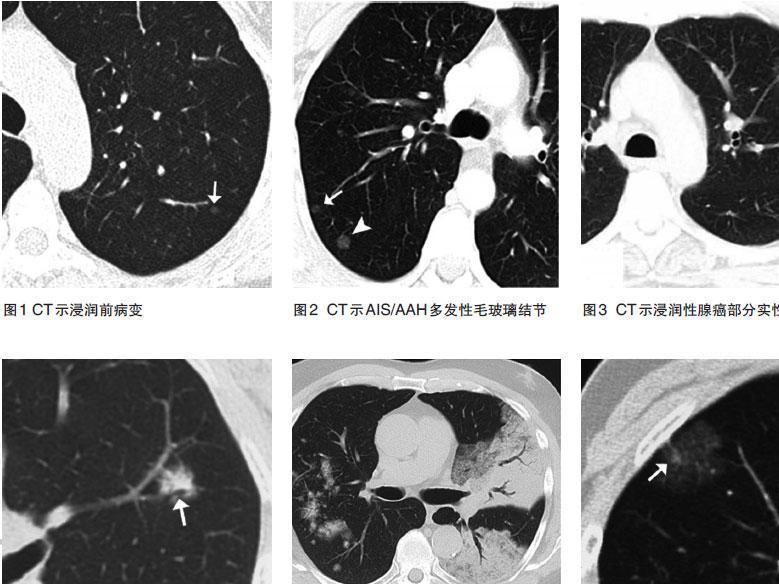 肺腺癌 搜狗百科