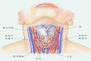 结节性甲状腺肿