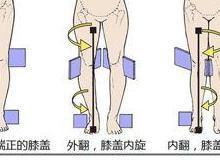 膝内翻