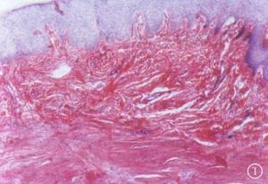 肛周脓肿瘢痕组织图片