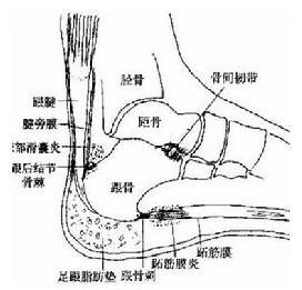 跟腱炎相关图片