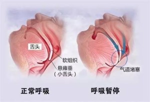 睡眠呼吸暂停低通气综合征